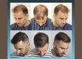 Spain’s Hair Transplant