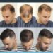 Spain’s Hair Transplant
